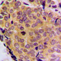 BCL2L2 / Bcl-w Antibody - Immunohistochemical analysis of BCLW staining in human breast cancer formalin fixed paraffin embedded tissue section. The section was pre-treated using heat mediated antigen retrieval with sodium citrate buffer (pH 6.0). The section was then incubated with the antibody at room temperature and detected using an HRP conjugated compact polymer system. DAB was used as the chromogen. The section was then counterstained with hematoxylin and mounted with DPX.