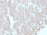 BCL6 Antibody - IHC testing of FFPE human lymphoma with Bcl6 antibody (clone BCL6/1527). Required HIER: boil tissue sections in 10mM Tris with 1mM EDTA, pH 9, for 10-20 min.