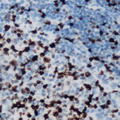 BCL6 Antibody - Immunohistochemical analysis of BCL6 staining in human lymphoma formalin fixed paraffin embedded tissue section. The section was pre-treated using heat mediated antigen retrieval with sodium citrate buffer (pH 6.0). The section was then incubated with the antibody at room temperature and detected using an HRP conjugated compact polymer system. DAB was used as the chromogen. The section was then counterstained with hematoxylin and mounted with DPX.
