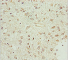BCS1L Antibody - Immunohistochemistry of paraffin-embedded human glioma cancer at dilution 1:100