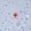 Beta Amyloid Antibody - Formalin-fixed, paraffin-embedded human brain of Alzheimer's disease stained with peroxidase-conjugate and AEC chromogen. Note staining of senile plaques.