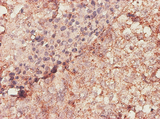 BGN / Biglycan Antibody - Immunohistochemistry of monoclonal antibody to BGN on formalin-fixed paraffin-embedded human lung, adenosquamous cell carcinoma. [antibody concentration 1 ~ 10 ug/ml]