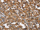 BGN / Biglycan Antibody - Immunohistochemistry of paraffin-embedded Human thyroid cancer using BGN Polyclonal Antibody at dilution of 1:50.