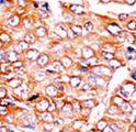 BID Antibody - Formalin-fixed and paraffin-embedded human cancer tissue reacted with the primary antibody, which was peroxidase-conjugated to the secondary antibody, followed by AEC staining. This data demonstrates the use of this antibody for immunohistochemistry; clinical relevance has not been evaluated. BC = breast carcinoma; HC = hepatocarcinoma.