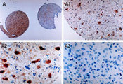 BIRC2 / cIAP1 Antibody - Immun histochemical analysis of cIAP1 expression in formalin-fixed, paraffin-embedded human gliomas from a brain tissue microarray using Polyclonal Antibody to cIAP1 at 1:2000. A. Two tissue cores showing a gemistocytoma, grade II tumor (left) and an anaplastic glioma-glioblastoma, grade IV tumor (right). A1 and A2, higher magnifications of the gemistocytoma. A3, higher magnification of the anaplastic glioma-glioblastoma. Hematoxylin-Eosin counterstain. Higher cIAP1 expression is seen in the less malignant tumor (gemistocytoma) than the more malignant anaplastic (glioma-glioblastoma) tumor.