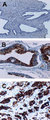 BIRC2 / cIAP1 Antibody - IHC of cIAP1 in formalin-fixed, paraffin-embedded human prostate using Polyclonal Antibody to cIAP1 at 1:2000. A, normal prostate. B, prostate intraepithelial neoplasia (PIN). PIN is a premalignant proliferation arising within the prostate. C, prostate cancer. Hematoxylin-Eosin counterstain. Increased cIAP1 expression is PIN and in prostate cancer compared to normal prostate.