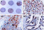 BIRC5 / Survivin Antibody - IHC of Survivin in a formalin-fixed, paraffin-embedded human brain tissue microarray using Polyclonal Antibody to Survivin at 1:2000. A. Differential expression of Survivin in brain tumors from six different patients. A1-A3, high magnification from A. A1, gemistocytic astrocytoma. A2, medulloblastoma. A3, choroid plexus papilloma. Hematoxylin-Eos in counterstain.