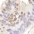BLAP75 / RMI1 Antibody - Detection of Human BLAP75 by Immunohistochemistry. Sample: FFPE section of human ovarian carcinoma. Antibody: Affinity purified rabbit anti-BLAP75 used at a dilution of 1:200 (1 ug/ml).