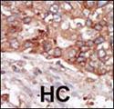 BLK Antibody - Formalin-fixed and paraffin-embedded human cancer tissue reacted with the primary antibody, which was peroxidase-conjugated to the secondary antibody, followed by AEC staining. This data demonstrates the use of this antibody for immunohistochemistry; clinical relevance has not been evaluated. BC = breast carcinoma; HC = hepatocarcinoma.