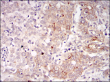 BLNK Antibody - IHC of paraffin-embedded human cervical cancer tissues using BLNK mouse monoclonal antibody with DAB staining.