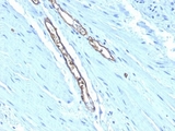 Blood Group A Antibody - Formalin-fixed, paraffin-embedded human colon carcinoma stained with Blood Group Antigen A antibody (HE-193).  This image was taken for the unmodified form of this product. Other forms have not been tested.