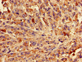 BLZF1 Antibody - Immunohistochemistry of paraffin-embedded human melanoma cancer at dilution of 1:100