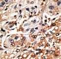 BMF Antibody - Formalin-fixed and paraffin-embedded human cancer tissue reacted with the primary antibody, which was peroxidase-conjugated to the secondary antibody, followed by DAB staining. This data demonstrates the use of this antibody for immunohistochemistry; clinical relevance has not been evaluated. BC = breast carcinoma; HC = hepatocarcinoma.