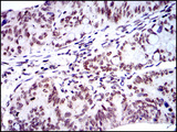 BMI1 / PCGF4 Antibody - IHC of paraffin-embedded rectum cancer tissues using BMI1 mouse monoclonal antibody with DAB staining.