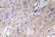 BMP3 Antibody - Immunohistochemistry analysis of BMP-3 antibody in paraffin-embedded human lung carcinoma tissue.