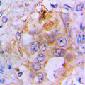 BMP3 Antibody - Immunohistochemical analysis of BMP3 staining in human lung cancer formalin fixed paraffin embedded tissue section. The section was pre-treated using heat mediated antigen retrieval with sodium citrate buffer (pH 6.0). The section was then incubated with the antibody at room temperature and detected using an HRP conjugated compact polymer system. DAB was used as the chromogen. The section was then counterstained with hematoxylin and mounted with DPX.