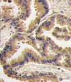BMP6 Antibody - Formalin-fixed and paraffin-embedded human lung carcinoma tissue reacted with Bmp6 antibody , which was peroxidase-conjugated to the secondary antibody, followed by DAB staining. This data demonstrates the use of this antibody for immunohistochemistry; clinical relevance has not been evaluated.