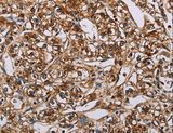 BMP6 Antibody - Immunohistochemistry of paraffin-embedded Human prostate cancer using BMP6 Polyclonal Antibody at dilution of 1:50.
