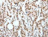 BNIP1 Antibody - Immunohistochemistry of paraffin-embedded Human breast cancer using BNIP1 Polyclonal Antibody at dilution of 1:60.