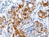 BPIFB3 / C20orf185 Antibody - Immunohistochemistry of paraffin-embedded Human lung cancer using BPIFB3 Polyclonal Antibody at dilution of 1:120.