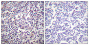 BRAF / B-Raf Antibody - Immunohistochemistry analysis of paraffin-embedded human lymph node tissue, using B-RAF Antibody. The picture on the right is blocked with the synthesized peptide.