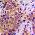 BRAF / B-Raf Antibody - Immunohistochemical analysis of B-RAF staining in human prostate cancer formalin fixed paraffin embedded tissue section. The section was pre-treated using heat mediated antigen retrieval with sodium citrate buffer (pH 6.0). The section was then incubated with the antibody at room temperature and detected using an HRP conjugated compact polymer system. DAB was used as the chromogen. The section was then counterstained with hematoxylin and mounted with DPX.