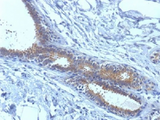 BRAP2 Antibody - IHC testing of FFPE human breast carcinoma tissue with BRCA1 antibody (clone BRCA1/1398). HIER: boil tissue sections in 10mM citrate buffer, pH 6.0, for 10-20 min.