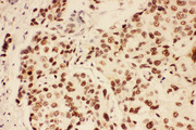 BRCA1 Antibody - BRCA1 antibody. IHC(P): Human Breast Cancer Tissue.