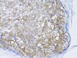 BRCA1 Antibody - Immunohistochemistry of paraffin-embedded human breast cancer using BRCA1 antibodyat dilution of 1:100 (40x lens).