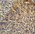 BRCTD1 / ANKRD32 Antibody - ANKRD32 Antibody immunohistochemistry of formalin-fixed and paraffin-embedded human cervix carcinoma followed by peroxidase-conjugated secondary antibody and DAB staining.