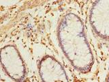 BRINP2 / FAM5B Antibody - Immunohistochemistry of paraffin-embedded human colon cancer using antibody at dilution of 1:100.