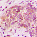 BRP44L Antibody - Immunohistochemical analysis of BRP44L staining in human breast cancer formalin fixed paraffin embedded tissue section. The section was pre-treated using heat mediated antigen retrieval with sodium citrate buffer (pH 6.0). The section was then incubated with the antibody at room temperature and detected using an HRP conjugated compact polymer system. DAB was used as the chromogen. The section was then counterstained with hematoxylin and mounted with DPX.
