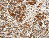 BRUCE / BIRC6 Antibody - Immunohistochemistry of paraffin-embedded Human gastric cancer using BIRC6 Polyclonal Antibody at dilution of 1:40.
