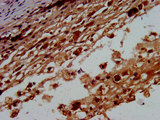 BTD / Biotinidase Antibody - Immunohistochemistry image at a dilution of 1:400 and staining in paraffin-embedded human melanoma cancer performed on a Leica BondTM system. After dewaxing and hydration, antigen retrieval was mediated by high pressure in a citrate buffer (pH 6.0) . Section was blocked with 10% normal goat serum 30min at RT. Then primary antibody (1% BSA) was incubated at 4 °C overnight. The primary is detected by a biotinylated secondary antibody and visualized using an HRP conjugated SP system.