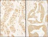 BTF3 Antibody - Detection of Human BTF3 by Immunohistochemistry. Sample: FFPE section of human breast carcinoma (left) and human prostate carcinoma (right). Antibody: Affinity purified rabbit anti-BTF3 used at a dilution of 1:1000 (1 ug/ml). Detection: DAB.