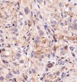 BTK Antibody - Immunohistochemistry: BTK [p Tyr223] Antibody - IHC of BTK in kidney cancer xenograft using DAB with hematoxylin counterstain.  This image was taken for the unconjugated form of this product. Other forms have not been tested.