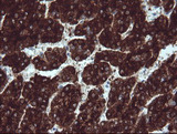 BTLA / CD272 Antibody - IHC of paraffin-embedded Carcinoma of Human liver tissue using anti-BTLA mouse monoclonal antibody.