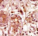 BUB1 Antibody - Formalin-fixed and paraffin-embedded human cancer tissue reacted with the primary antibody, which was peroxidase-conjugated to the secondary antibody, followed by AEC staining. This data demonstrates the use of this antibody for immunohistochemistry; clinical relevance has not been evaluated. BC = breast carcinoma; HC = hepatocarcinoma.