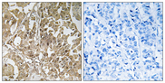 BUB1 Antibody - Immunohistochemistry analysis of paraffin-embedded human breast carcinoma tissue, using BUB1 Antibody. The picture on the right is blocked with the synthesized peptide.
