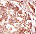 BUB1B / BubR1 Antibody - Formalin-fixed and paraffin-embedded human cancer tissue reacted with the primary antibody, which was peroxidase-conjugated to the secondary antibody, followed by DAB staining. This data demonstrates the use of this antibody for immunohistochemistry; clinical relevance has not been evaluated. BC = breast carcinoma; HC = hepatocarcinoma.