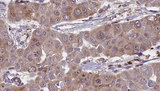 BVES Antibody - 1:100 staining human liver carcinoma tissues by IHC-P. The sample was formaldehyde fixed and a heat mediated antigen retrieval step in citrate buffer was performed. The sample was then blocked and incubated with the antibody for 1.5 hours at 22°C. An HRP conjugated goat anti-rabbit antibody was used as the secondary.