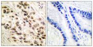 C/EBP Beta / CEBPB Antibody - Immunohistochemistry analysis of paraffin-embedded human lung carcinoma tissue, using C/EBP-beta Antibody. The picture on the right is blocked with the synthesized peptide.