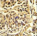 C/EBP Beta / CEBPB Antibody - Formalin-fixed and paraffin-embedded human lung carcinoma reacted with CEBPB Antibody , which was peroxidase-conjugated to the secondary antibody, followed by DAB staining. This data demonstrates the use of this antibody for immunohistochemistry; clinical relevance has not been evaluated.