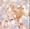 c-Kit / CD117 Antibody - Purified rabbit anti-KIT antibody was used in immunohistochemistry on Breast Carcinoma.