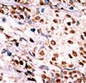 c-Met Antibody - Formalin-fixed and paraffin-embedded human cancer tissue reacted with the primary antibody, which was peroxidase-conjugated to the secondary antibody, followed by AEC staining. This data demonstrates the use of this antibody for immunohistochemistry; clinical relevance has not been evaluated. BC = breast carcinoma; HC = hepatocarcinoma.