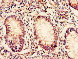 C10orf32 Antibody - Immunohistochemistry of paraffin-embedded human colon cancer using BORCS7 Antibody at dilution of 1:100