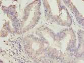 C10orf82 Antibody - Immunohistochemistry of paraffin-embedded human endometrial cancer using antibody at dilution of 1:100.