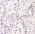 C11orf30 / EMSY Antibody - Detection of Human EMSY by Immunohistochemistry. Sample: FFPE section of human stomach carcinoma. Antibody: Affinity purified rabbit anti-EMSY used at a dilution of 1:1000 (1Detection: DAB.