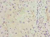 C11orf53 Antibody - Immunohistochemistry of paraffin-embedded human liver cancer using antibody at dilution of 1:100.