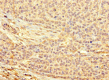 C13orf39 Antibody - Paraffin-embedding Immunohistochemistry using human ovarian cancer at dilution 1:100